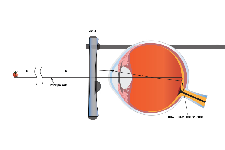 Concave lens of glasses used to focus image on eyes retina